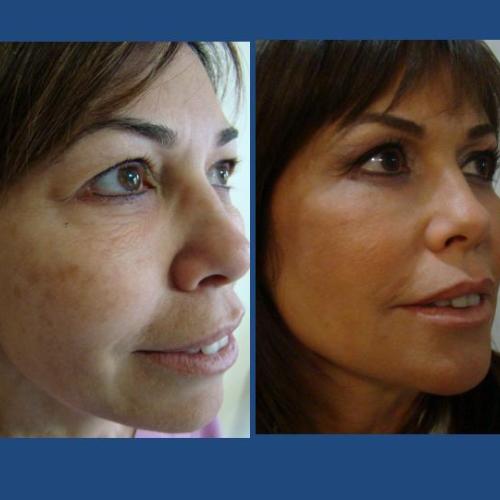 Blepharoplasty Before / After photo